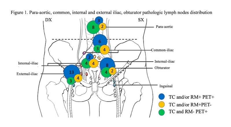internal iliac lymph nodes